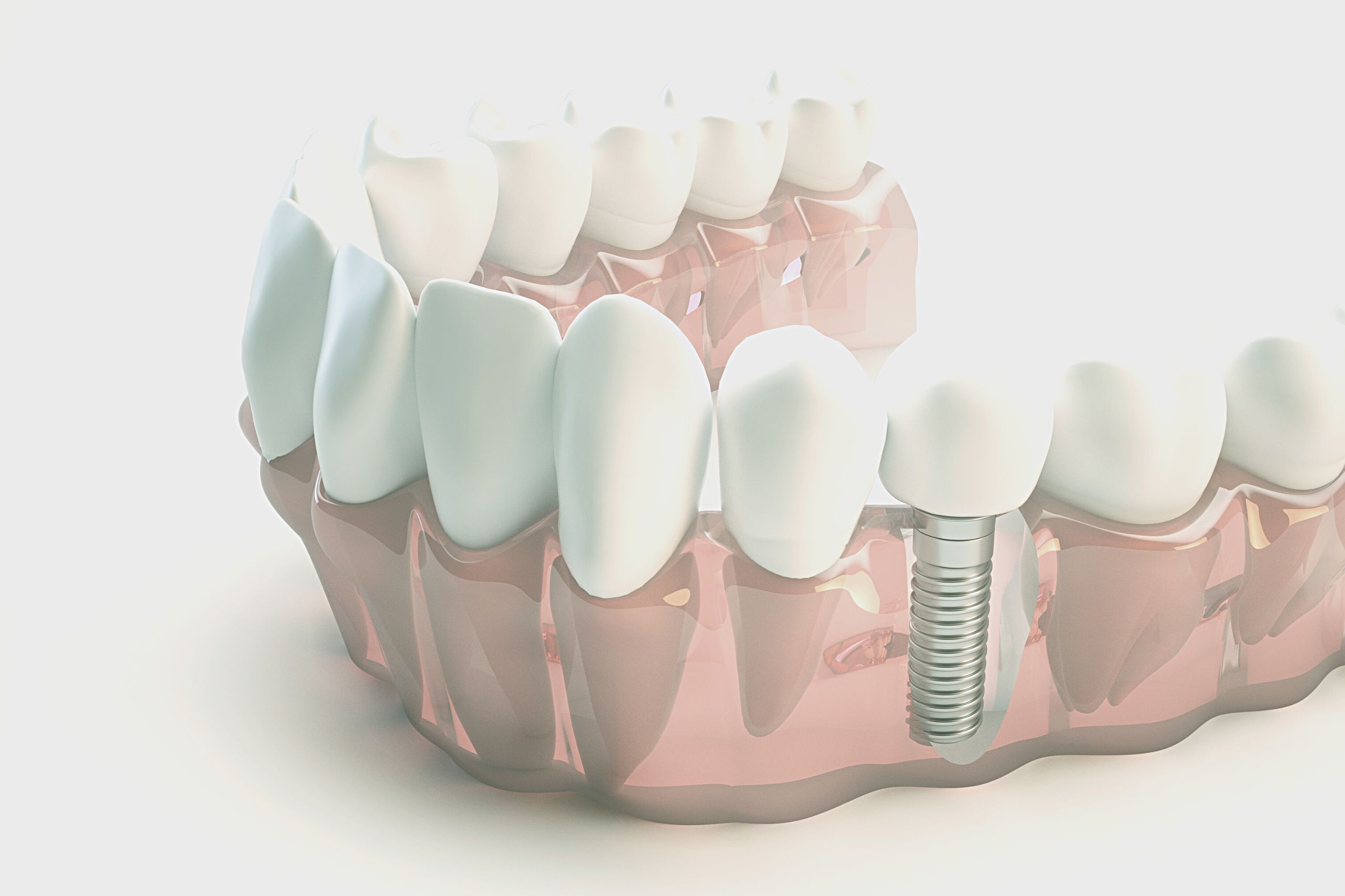 Dental Implants